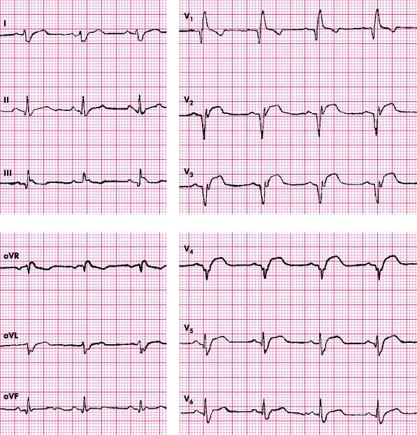 Blok tylnej wiązki lewej odnogi pęczka Hisa - Podstawy EKG - EKG