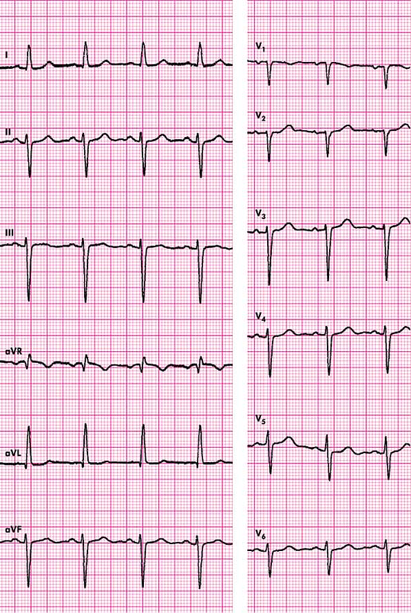 Blok Lewej Odnogi Peczka Hisa A Stres Blok przedniej wiązki lewej odnogi pęczka Hisa - Podstawy EKG - EKG - Kardiologia - Medycyna