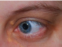 Łagodne zmiany guzkowe powiek - Powieki i układ łzowy - Choroby oczu