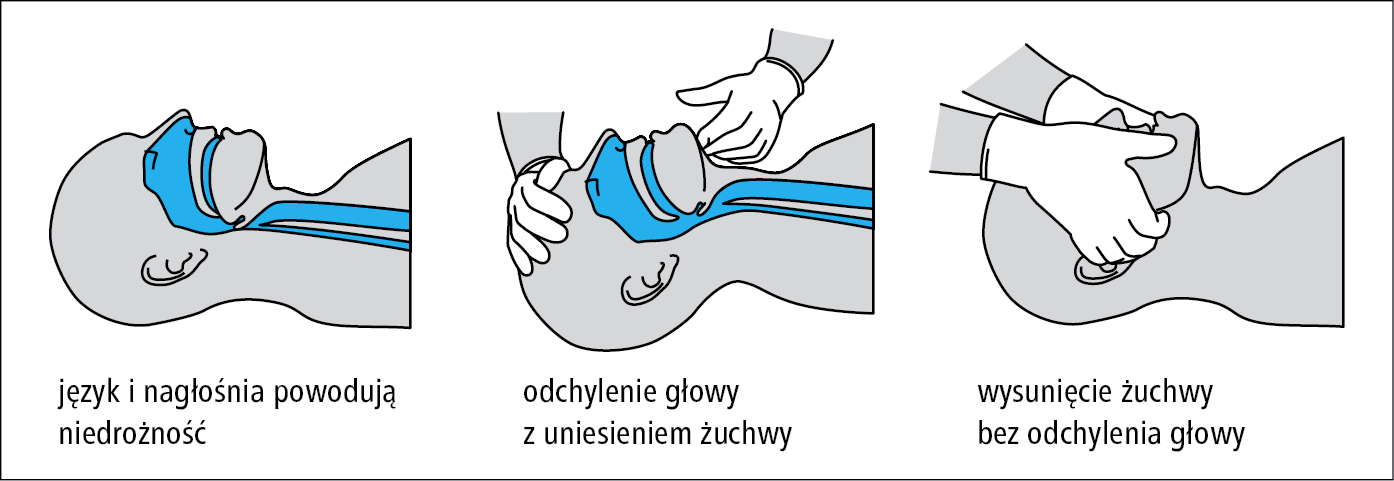Nagłe zatrzymanie krążenia - Choroby układu krążenia - Choroby