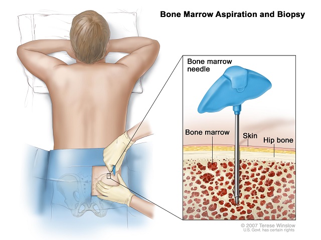 Bone Marrow Aspiration and Biopsy