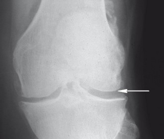 Choroba zwyrodnieniowa stawu kolanowego: zdjęcie RTG