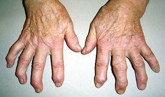 Zwyrodnienie stawów - wygląd rąk - zdjęcie