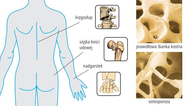 Osteoporoza – boala “silentioasa” la care trebuie sa fim atenti | paradisulbunicilor.ro