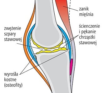 choroba zwyrodnieniowa stawów artroza articulației spire a piciorului