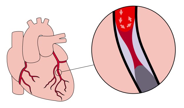 Zawał. Zwężenie tętnicy doprowadzającej krew do mięśnia sercowego