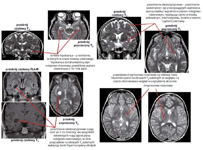 Prawidłowa Budowa Anatomiczna Mózgu Na Obrazach Tk I Mr Oraz Niektóre Odmiany Normy Strona 2 6939