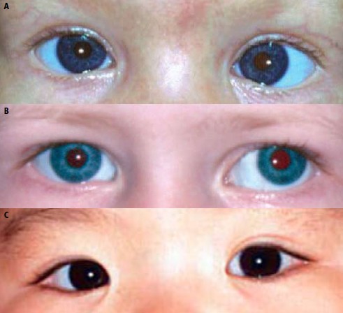 Przesiewowe Badanie Wzroku U Malych Dzieci W Podstawowej Opiece Zdrowotnej Artykuly Przegladowe Okulistyka Dla Nieokulistow Okulistyka Medycyna Praktyczna Dla Lekarzy