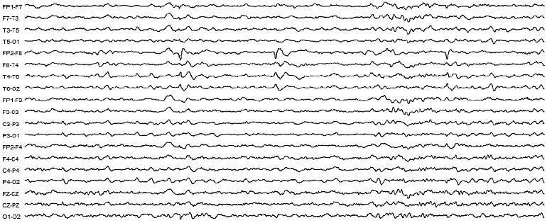 Elektroencefalografia. Napady lęku u 32-letniego mężczyzny - EEG
