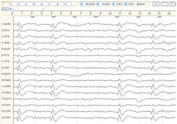 Elektroencefalografia. 20-letni mężczyzna chory na padaczkę z