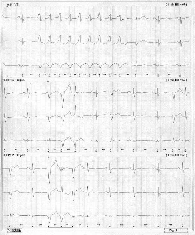 Zaburzenia Rytmu Serca I Przewodzenia 32 Letni Mężczyzna Z Arytmią Przypadki Kardiologia 2706