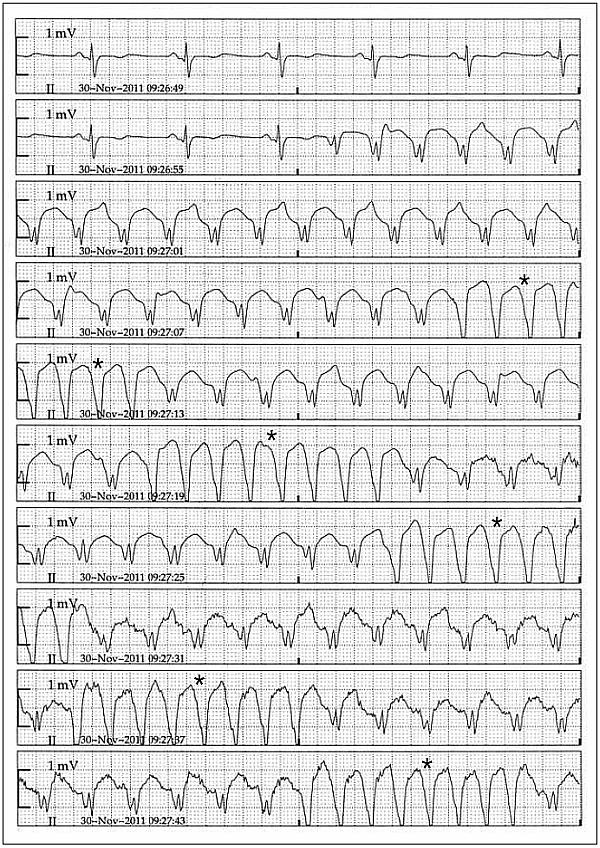 Zaburzenia Rytmu Serca I Przewodzenia 32 Letni Mężczyzna Z Arytmią Przypadki Kardiologia 4962