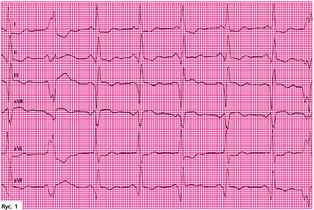 Elektrokardiografia Rutynowy Elektrokardiogram Ekg Cykle Tematyczne Artykuły Medycyna 8428