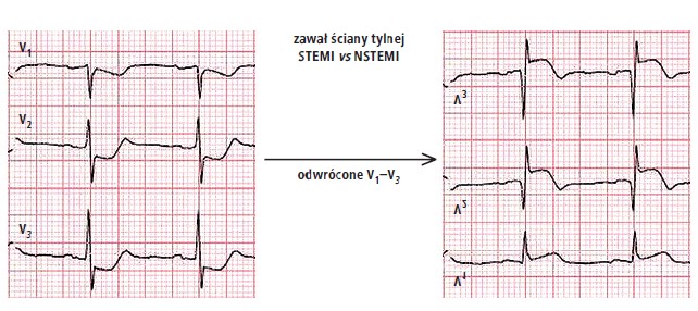 Pu apki W Elektrokardiograficznym Rozpoznawaniu Zawa u Serca Cz 1 pu-apki-w-elektrokardiograficznym-rozpoznawaniu-zawa-u-serca-cz-1