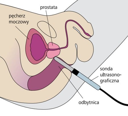 USG przezodbytnicze prostaty