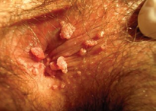 Na zdjęciu kłykciny kończyste w&nbsp;okolicy odbytu – miękkie, różowawe brodawki spowodowane zakażeniem wirusem HPV