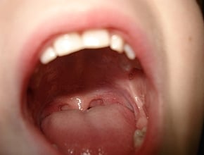 Kandydoza Blony Sluzowej Jamy Ustnej Stomatologia Medycyna Praktyczna Dla Pacjentow