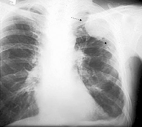 zdjęcie RTG - Rak płuca