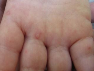 Choroba dłoni, stóp i ustnej | Pediatria - mp.pl