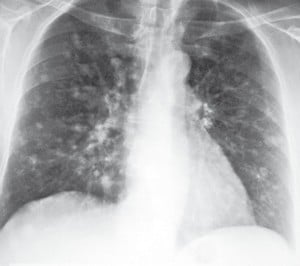 Obraz przerzutów do obu płuc w RTG klatki piersiowej