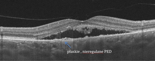 Rola Oct I Angio Oct W Diagnostyce Chorób Plamki Związanych Ze Zwiększoną Grubością Naczyniówki 8237