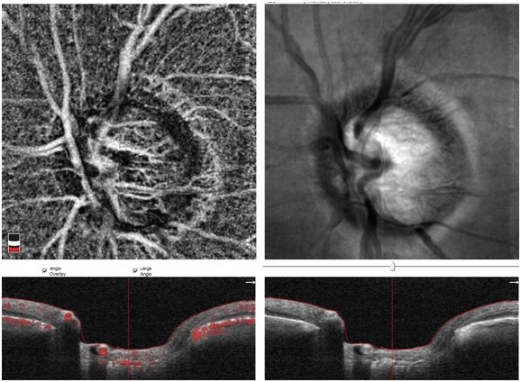 Angio Oct W Diagnostyce Jaskry Ekspert Okulistyka Medycyna Praktyczna Dla Lekarzy 1835