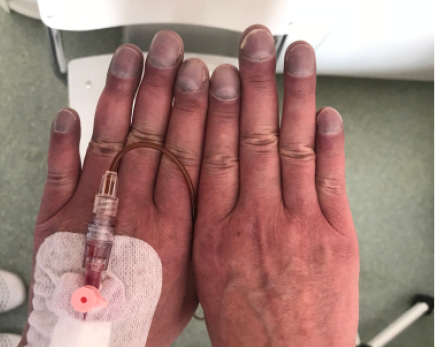 Pałeczkowate palce i paznokcie w kształcie szczkiełka od zegarka u pacjenta z zespołem Eisenmengera - zdjęcie