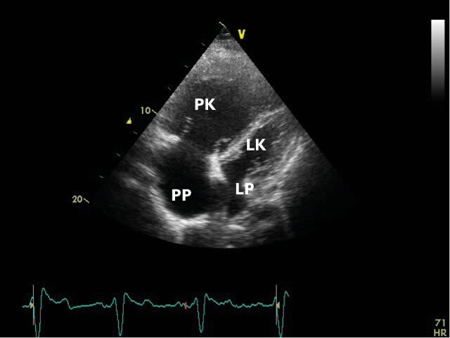 Obraz echokardiograficzny serca u pacjenta z TNP - zdjęcie