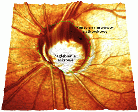 Zaawansowana neuropatia jaskrowa w trójwymiarowym obrazie HRT