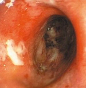Obraz endoskopowy colitis ulcerosa