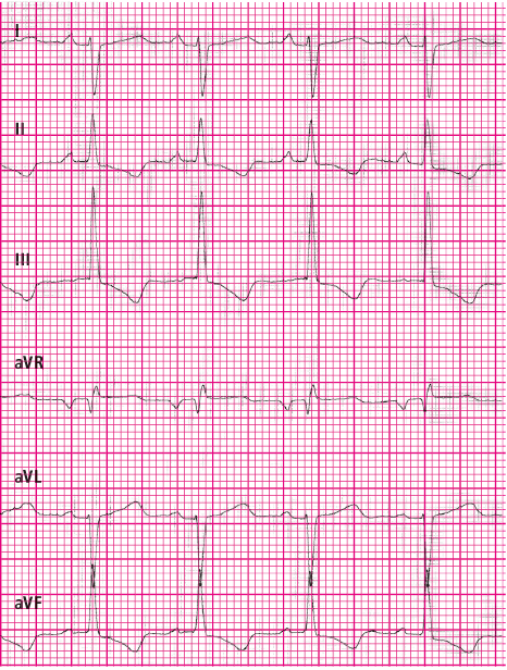 Rola EKG u dziecka z bólem w klatce piersiowej cz. 6 - Pediatria - EKG
