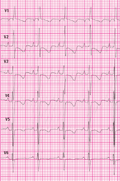 Rola EKG u dziecka z bólem w klatce piersiowej cz. 6 - Pediatria - EKG
