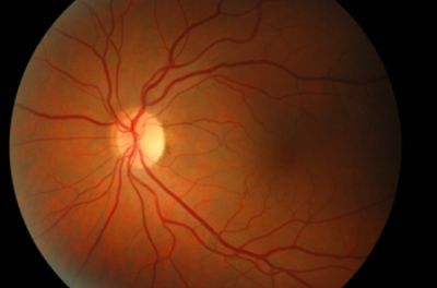 Częściowy zanik tarczy nerwu wzrokowego w przebiegu neuropatii toksycznej