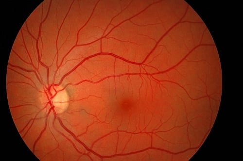 Obraz tarczy nerw wzrokowego w przebiegu zapalenia pozagałkowego