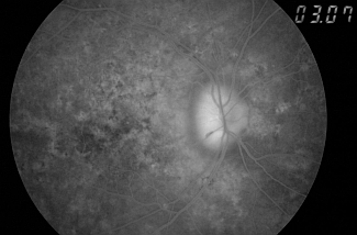 Obraz tarczy nerwu wzrokowego w AION we późnej fazie angiografii fluoresceinowej