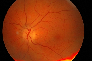 Obraz tarczy nerwu wzrokowego w ostrej fazie przedniej niedokrwiennej neuropatii nerwu wzrokowego