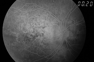 Obraz tarczy nerwu wzrokowego w AION we wczesnej fazie angiografii fluoresceinowej