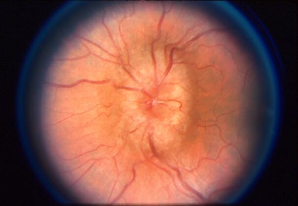 Obraz tarczy zastoinowej w badaniu oftalmoskopowym