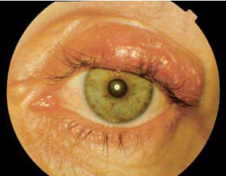 Ostry ból oka | Okulistyka - Medycyna Praktyczna dla pacjentów