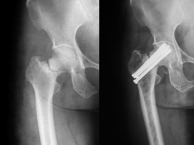 Złamanie szyjki kości udowej – przed operacją oraz po operacji zespolenia złamania za pomocą śrub - zdjęcie