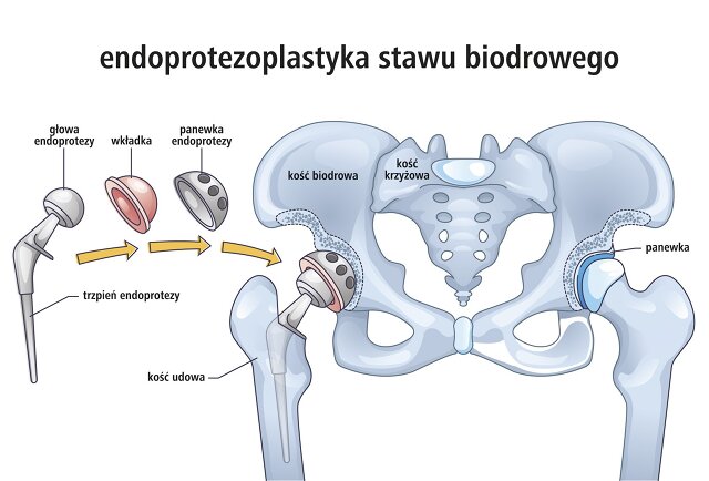 endoprotezoplastyka stawu biodrowego - infografika