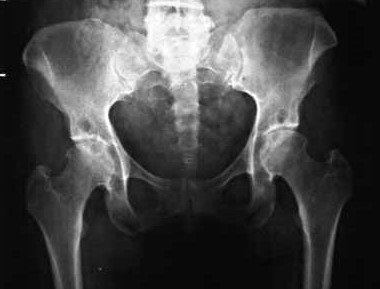 Zlamanie Szyjki Kosci Udowej Ortopedia Medycyna Praktyczna Dla Pacjentow
