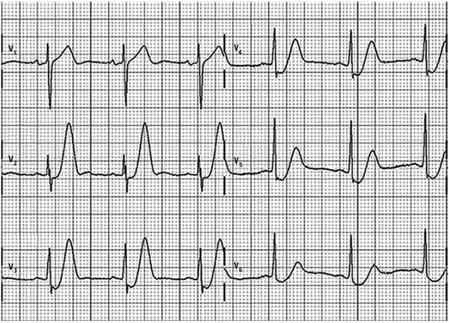 Pułapki W Elektrokardiograficznym Rozpoznawaniu Zawału Serca Cz 4 Strona 2 Polecane 5450
