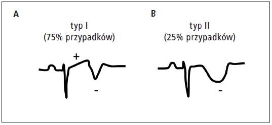 Pułapki W Elektrokardiograficznym Rozpoznawaniu Zawału Serca Cz 3 Polecane Artykuły Ekg 0064
