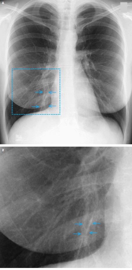 Kobieta po ostrym zapaleniu oskrzeli - Radiologia - Praktyka kliniczna