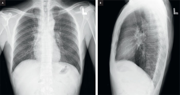 normal chest x ray images