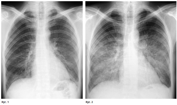pneumocystoza RTG płuc 