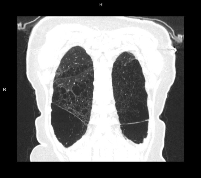 Jaka patologia widoczna jest na radiogramie i tomografii? cz. 216