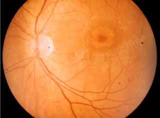 Dystrofia czopkowa – zaawansowane zmiany w plamce w postaci „wolego oka”