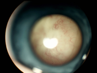 Siatkówczak – guz wypełniający prawie całą gałkę oczną i powodujący powstanie białego odblasku w obrębie źrenicy (tzw. leukokoria)